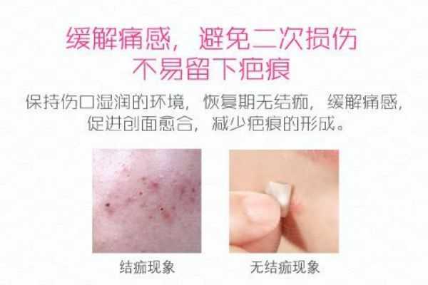 曼秀雷顿痘痘贴怎么样 曼秀雷顿痘痘贴怎么样
