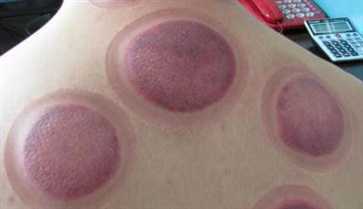 拔罐黑紫色说明什么 拔罐黑紫色说明什么