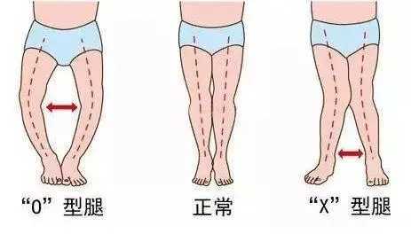 日式整骨能矫正o型腿吗 日式整骨能矫正o型腿吗