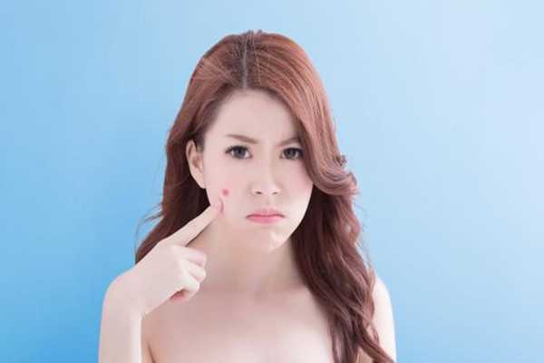 脸上的痘痘能用手挤吗