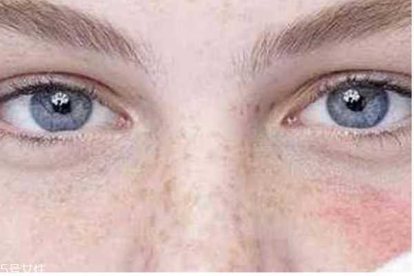 脸过敏了怎么快速脱敏