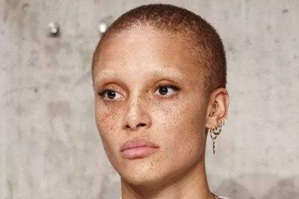 雀斑对身体有影响吗 雀斑可以做光子嫩肤吗