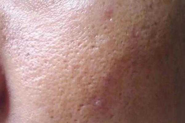 毛孔粗大要补水还是控油 毛孔粗大要补水还是控油