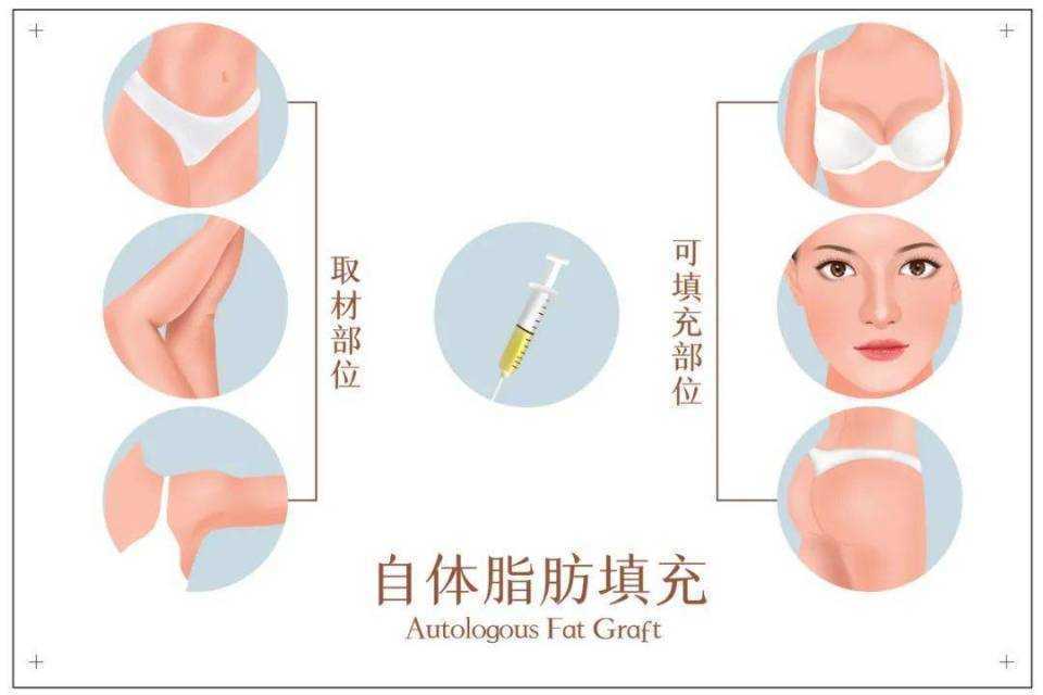 做脂肪填充全脸好吗？多久可以恢复