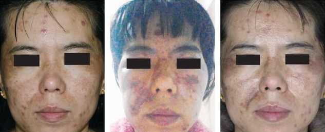 甘醇酸60可以刷脸吗？在家用甘醇酸刷酸教程