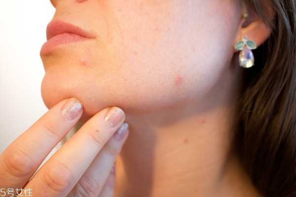 狂长痘痘怎么办