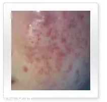 平衡露什么成分能祛痘