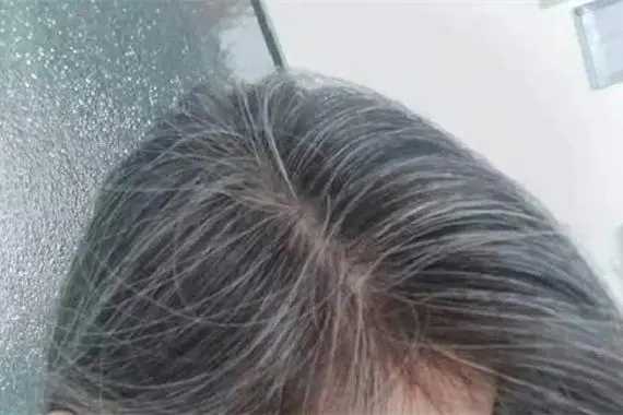 植发医院哪家医技术好 植发医院哪家医技术好