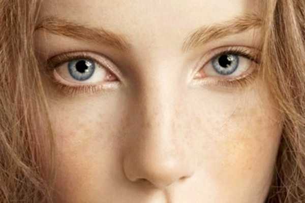 晒斑可以自然消失吗？晒斑可以用激光去掉吗