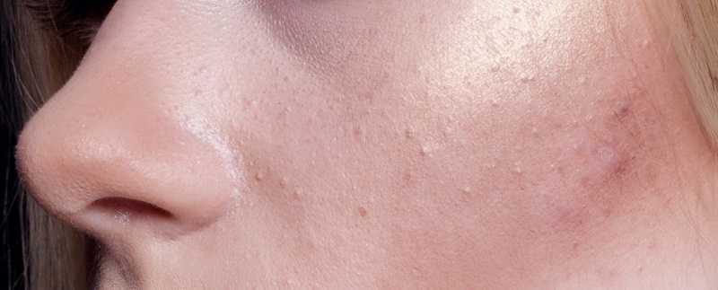 如何解决闭口粉刺问题 如何解决闭口粉刺问题