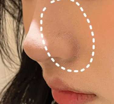 鼻子两侧起皮是什么肤质 鼻子两侧起皮是什么肤质