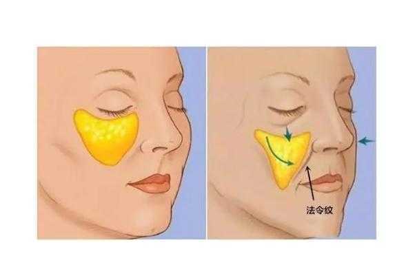 法令纹是怎么导致出来的 法令纹去除最好的方法