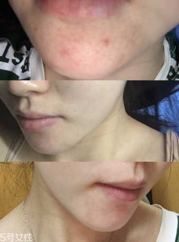 冻干粉的用法 冻干粉的正确使用方法 冻干粉的用法 冻干粉的正确使用方法