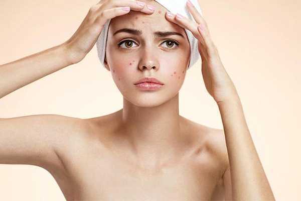 冻干粉用完爆痘正常吗 冻干粉用完爆痘正常吗