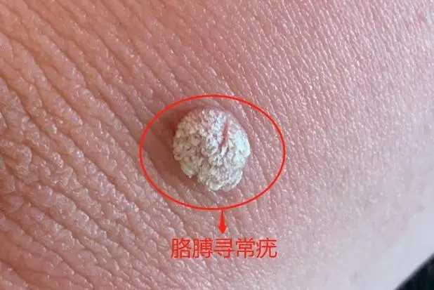 感染hpv的痘痘长啥样(附图) 感染hpv的痘痘长啥样(附图)