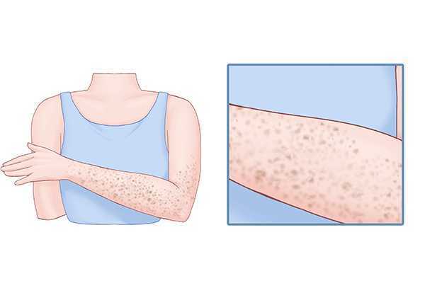 三伏贴导致黑印如何消掉 三伏贴导致黑印如何消掉