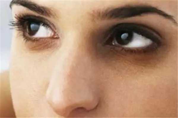 黑眼圈一直不消怎么办 黑眼圈一直不消怎么办