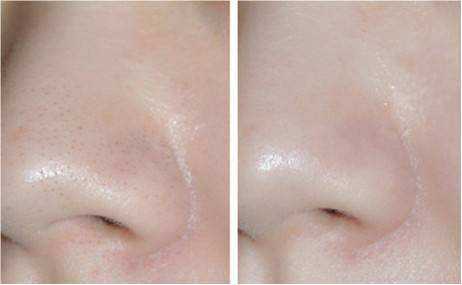 去黑头面膜怎么用