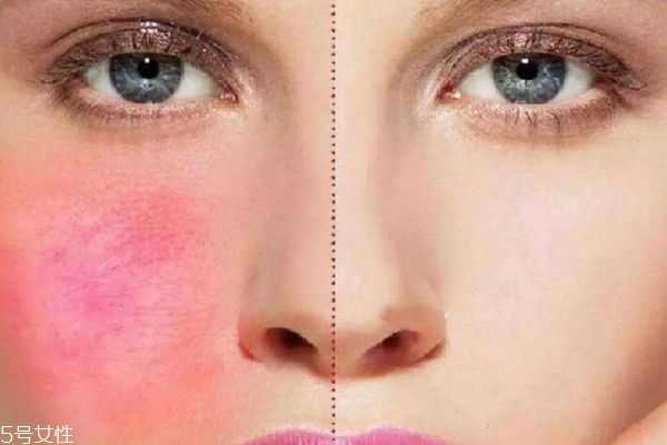 洋甘菊去红血丝吗