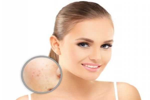 痘痘里为什么会有脓