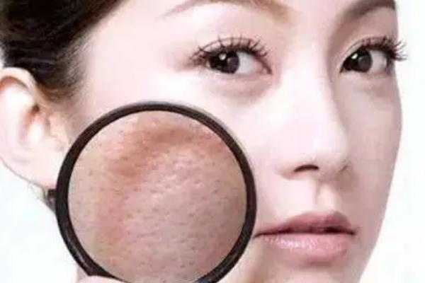 毛孔粗大有痘坑怎么修复 毛孔粗大有几种类型