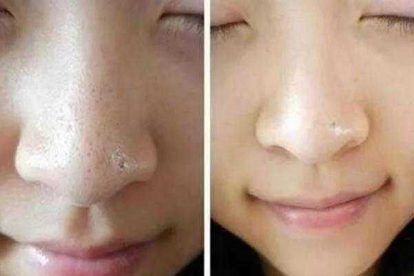 去黑头最有效的药膏 去黑头收缩毛孔的最好方法