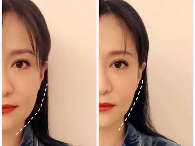 整骨脸部大概多少钱 整骨脸部大概多少钱