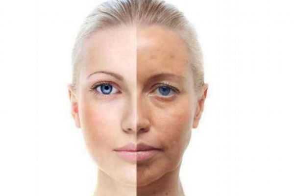 怎么去除脸上的斑