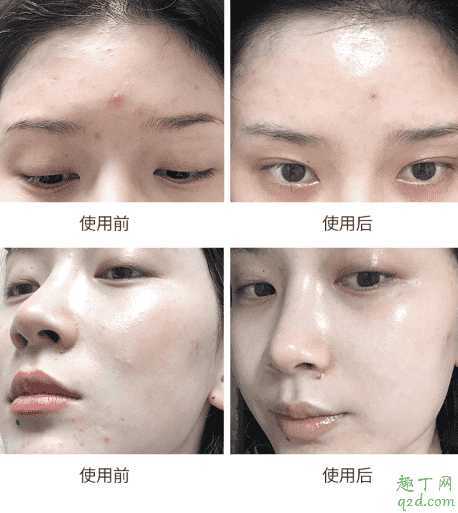 科娜蓝面霜爆痘真的可以修复好吗？科娜蓝面霜孕妇能用吗