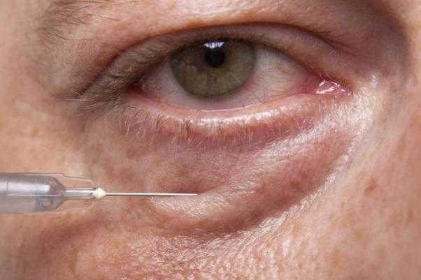 眼袋会不会遗传？眼袋能自然消除吗