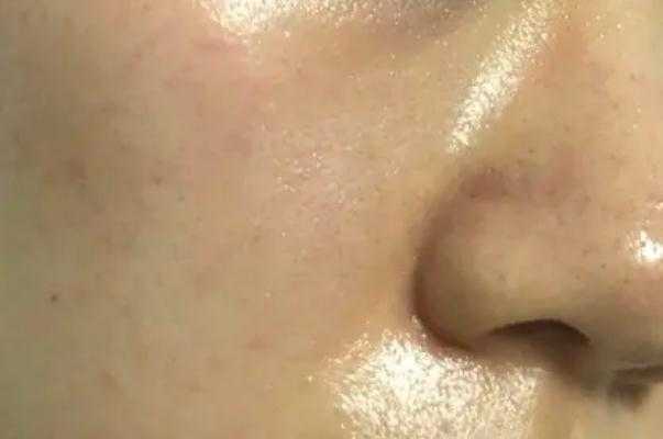 皮肤出油多是什么原因 皮肤出油严重毛孔粗大如何改善