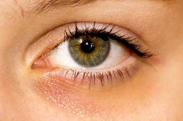 黑眼圈能自己消除吗 黑眼圈手术一般多少钱