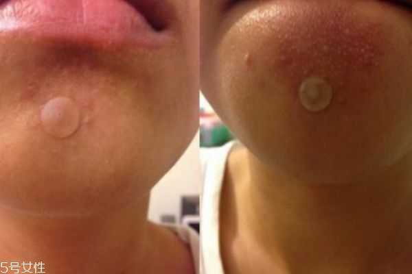 曼秀雷顿痘痘贴怎么样 曼秀雷顿痘痘贴怎么样