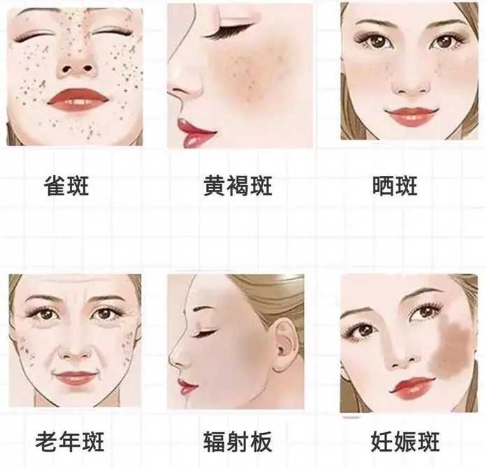 妊娠斑和黄褐斑的区别 妊娠斑和黄褐斑的区别