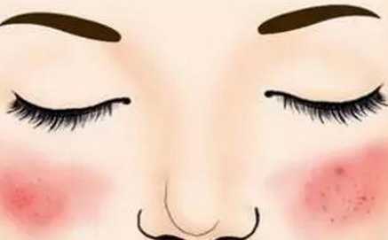 什么是激素脸？怎么形成的