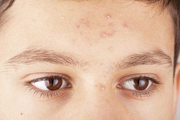 长痘痘能化妆吗 长痘痘能化妆吗