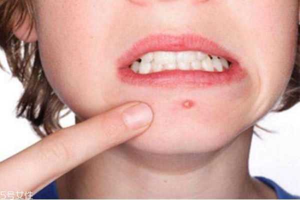 下巴上长痘痘是什么原因