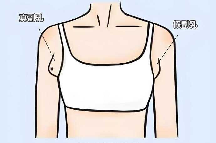 美容院里消除副乳?实话说,不靠谱 美容院里消除副乳?实话说,不靠谱