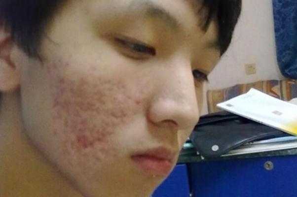 青春痘怎么快速消除？青春痘一般多久会消失