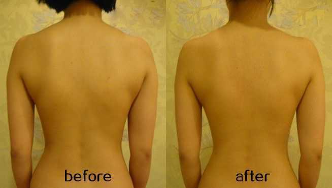 徒手整骨整形前后对比照片