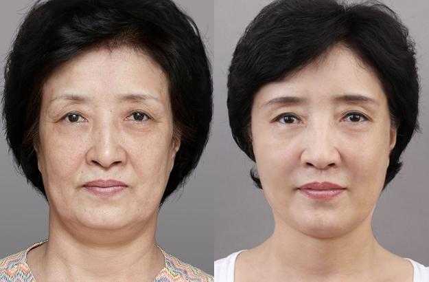 紧致皮肤最有效的方法 紧致皮肤除皱的方法 紧致皮肤最有效的方法 紧致皮肤除皱的方法