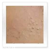 平衡露什么成分能祛痘