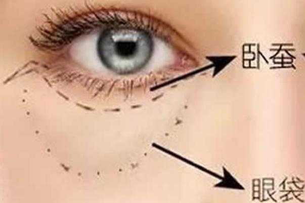 眼袋是脾虚引起的吗 眼袋是哪个经络堵塞
