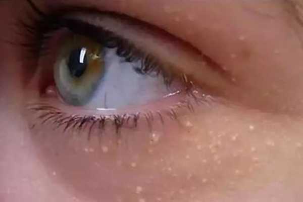 去脂肪粒的药膏