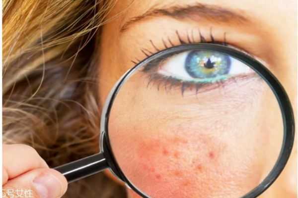 脸上经常去角质好吗