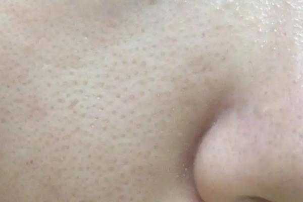 毛孔粗大是缺乏什么维生素 毛孔粗大是什么意思