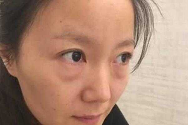 眼袋可以针灸治疗吗 眼袋可以按摩去除吗