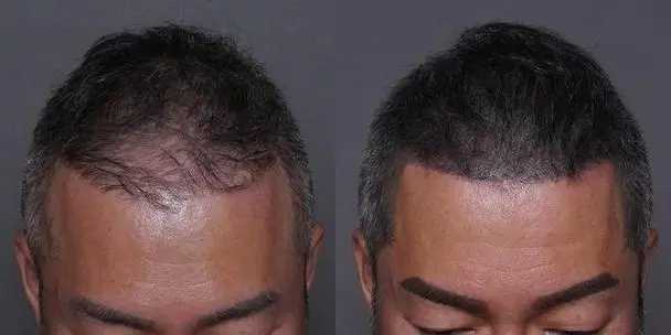 纹发和植发的区别在哪里?哪个贵? 纹发和植发的区别在哪里?哪个贵?