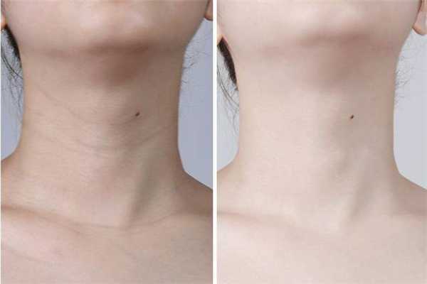 颈纹是怎么引起的？颈纹怎么消除简单的方法