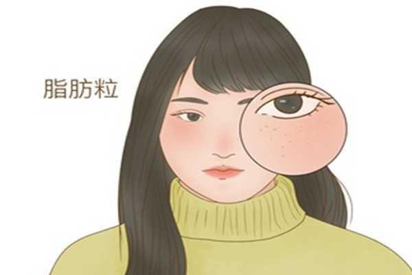 脂肪粒怎么祛除?这6点需要注意 脂肪粒怎么祛除?这6点需要注意